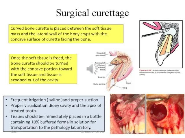 Surgical curettage Curved bone curette is placed between the soft