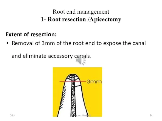 Root end management 1- Root resection /Apicectomy Extent of resection: