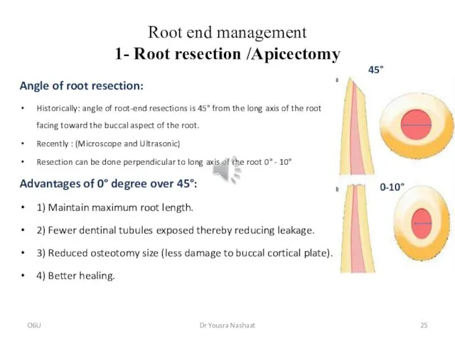 Root end management 1- Root resection /Apicectomy Angle of root