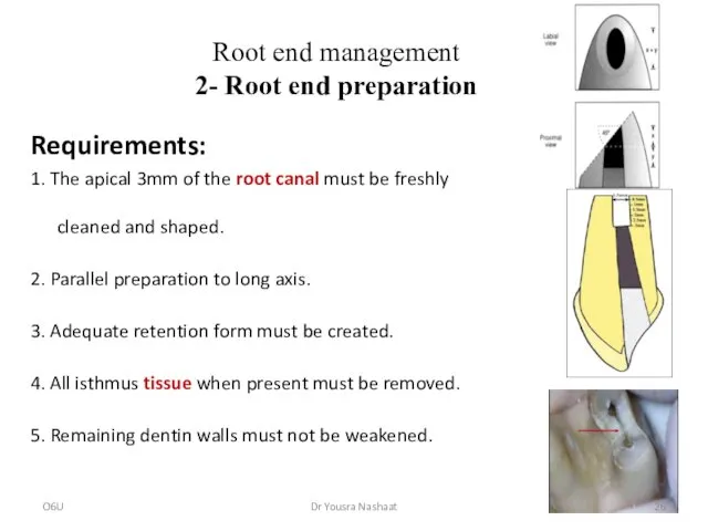 Root end management 2- Root end preparation Requirements: 1. The