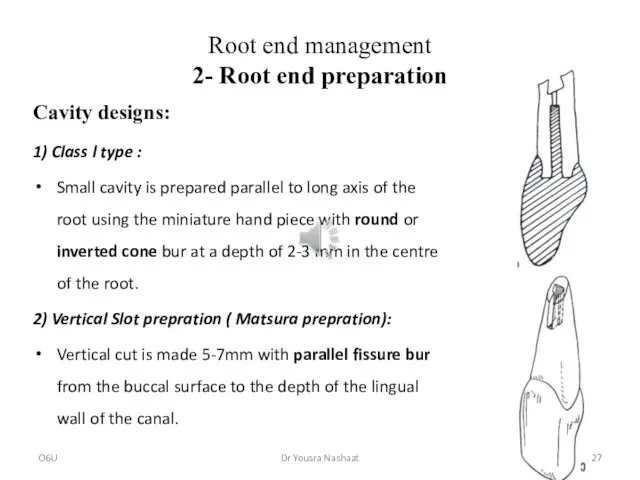 Root end management 2- Root end preparation Cavity designs: 1)
