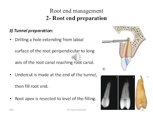 Root end management 2- Root end preparation 3) Tunnel preparation: