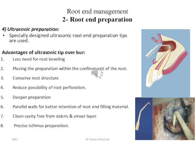 Root end management 2- Root end preparation 4) Ultrasonic preparation: