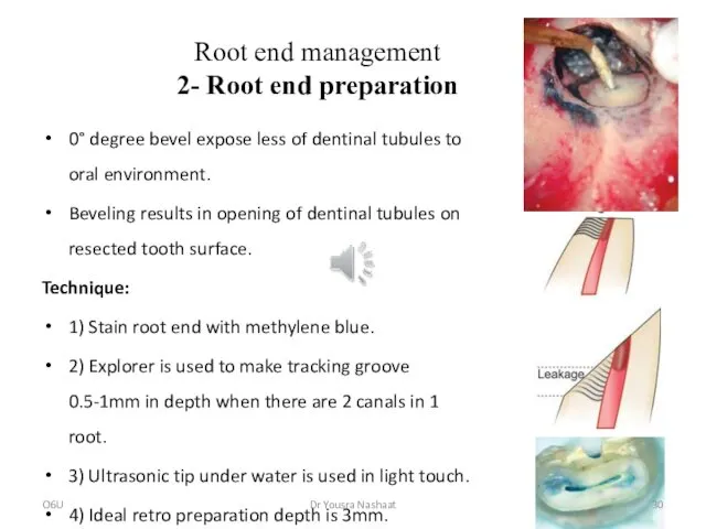 Root end management 2- Root end preparation 0° degree bevel