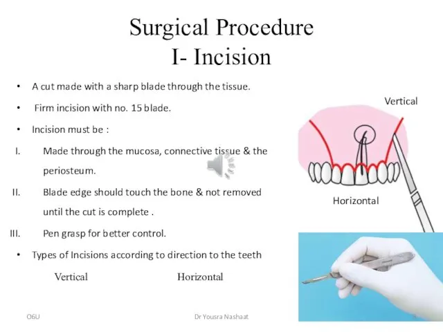 Surgical Procedure I- Incision A cut made with a sharp