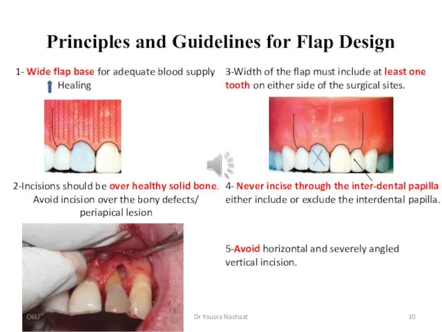 Principles and Guidelines for Flap Design 1- Wide flap base