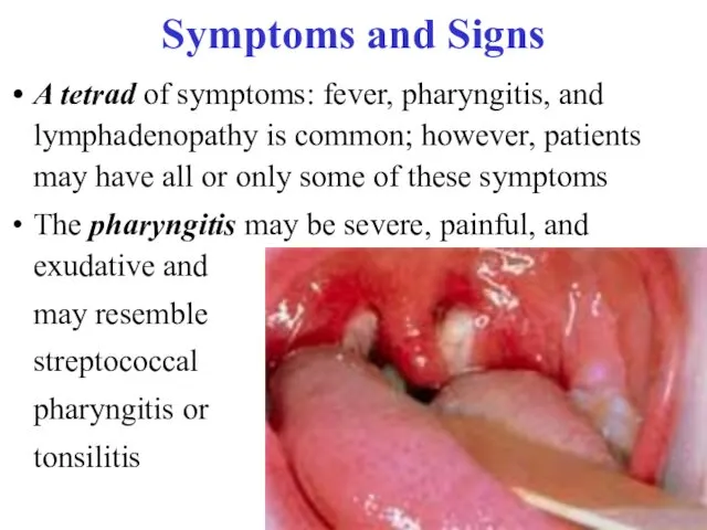 Symptoms and Signs A tetrad of symptoms: fever, pharyngitis, and