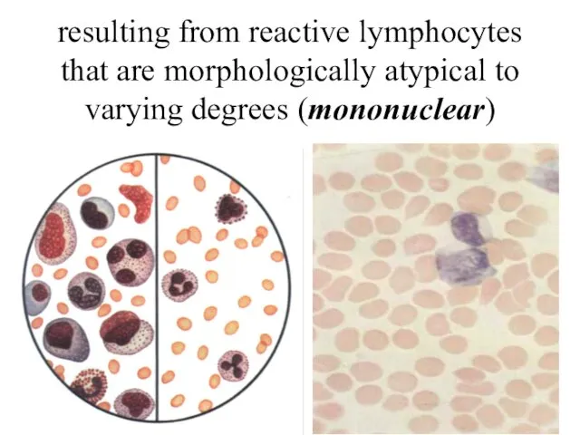 resulting from reactive lymphocytes that are morphologically atypical to varying degrees (mononuclear)