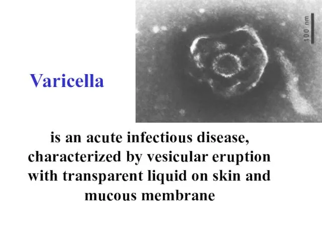 Varicella is an acute infectious disease, characterized by vesicular eruption