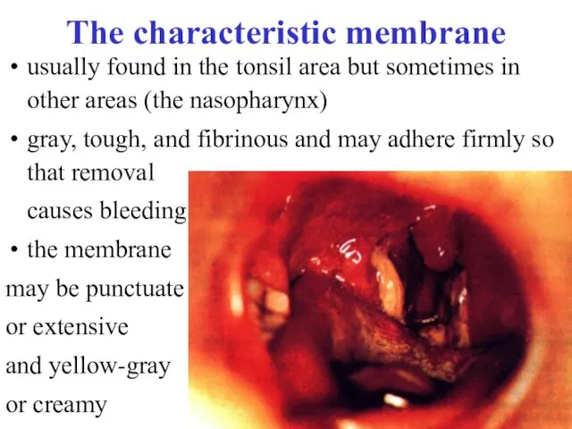 The characteristic membrane usually found in the tonsil area but