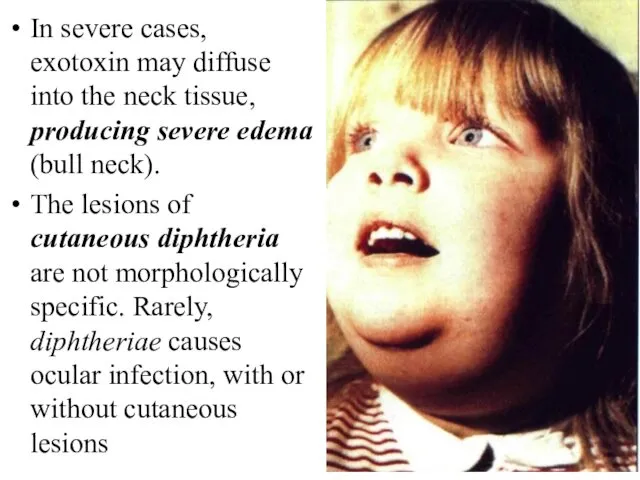 In severe cases, exotoxin may diffuse into the neck tissue,