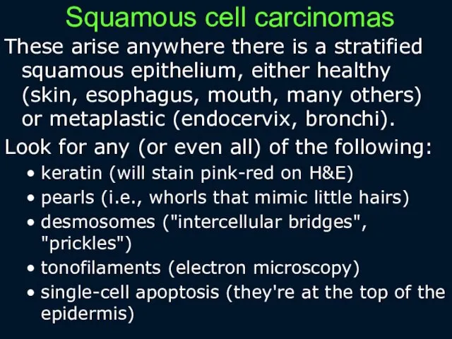 Squamous cell carcinomas These arise anywhere there is a stratified