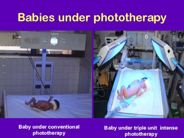 Babies under phototherapy Baby under conventional phototherapy Baby under triple unit intense phototherapy