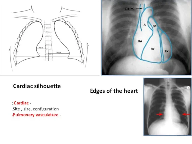 Cardiac silhouette Edges of the heart - Cardiac : Site , size, configuration. - Pulmonary vasculature.