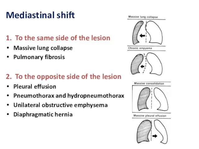 Mediastinal shift 1. To the same side of the lesion