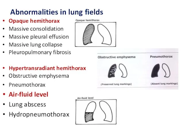 Abnormalities in lung fields Opaque hemithorax Massive consolidation Massive pleural