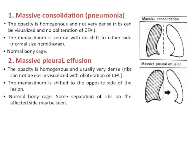 1. Massive consolidation (pneumonia) The opacity is homogenous and not