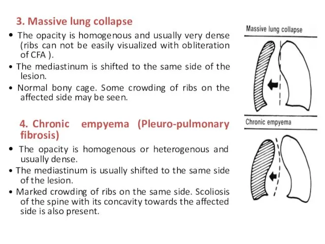 3. Massive lung collapse • The opacity is homogenous and
