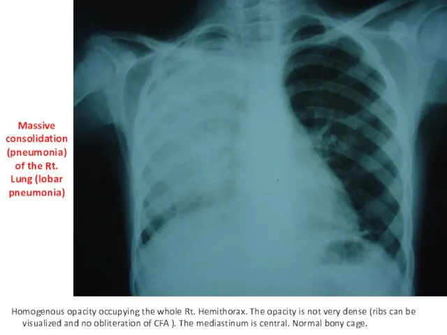 Massive consolidation (pneumonia) of the Rt. Lung (lobar pneumonia) Homogenous