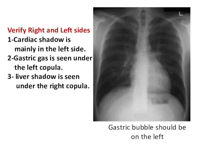 Gastric bubble should be on the left Verify Right and