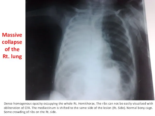 Dense homogenous opacity occupying the whole Rt. Hemithorax. The ribs