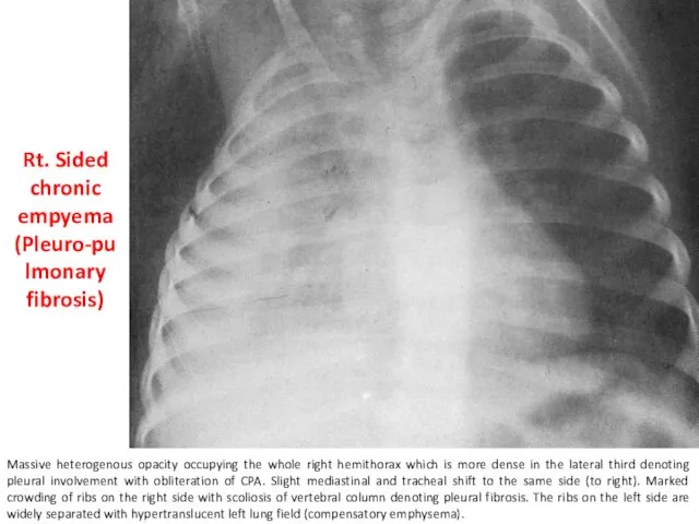 Rt. Sided chronic empyema (Pleuro-pulmonary fibrosis) Massive heterogenous opacity occupying
