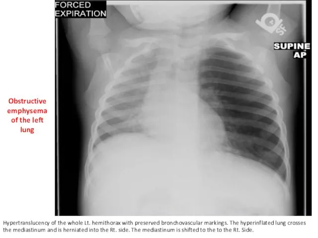 Obstructive emphysema of the left lung Hypertranslucency of the whole