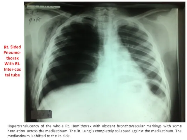 Rt. Sided Pneumo-thorax With Rt. Inter-costal tube Hypertranslucency of the