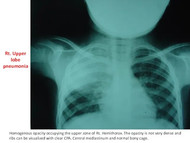 Rt. Upper lobe pneumonia Homogenous opacity occupying the upper zone