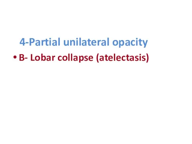 4-Partial unilateral opacity B- Lobar collapse (atelectasis)