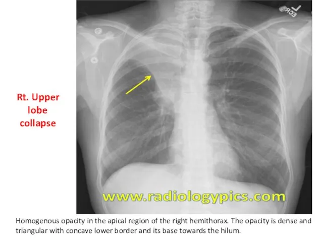 Rt. Upper lobe collapse Homogenous opacity in the apical region