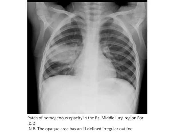 Patch of homogenous opacity in the Rt. Middle lung region