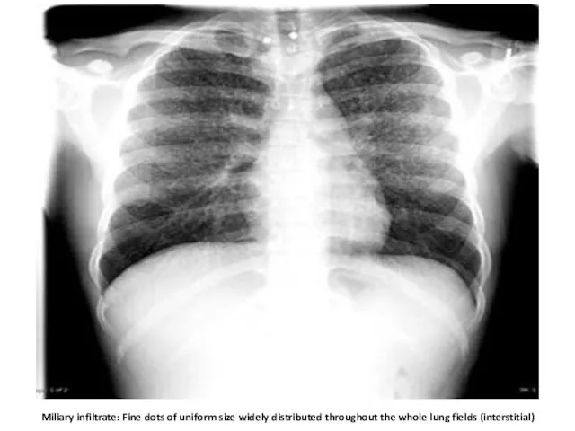 Miliary infiltrate: Fine dots of uniform size widely distributed throughout the whole lung fields (interstitial)