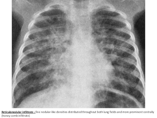 Reticulonodular infiltrate : fine nodular-like densities distributed throughout both lung