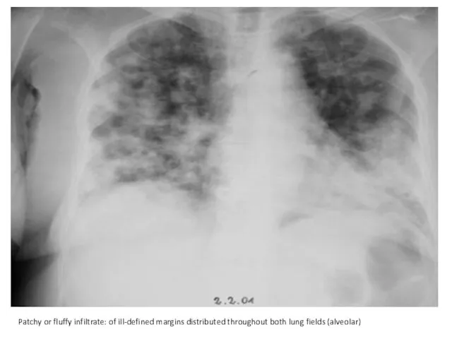 Patchy or fluffy infiltrate: of ill-defined margins distributed throughout both lung fields (alveolar)