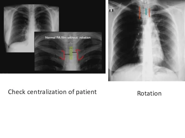 Rotation Check centralization of patient