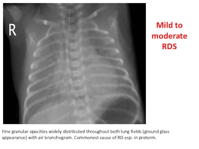 Fine granular opacities widely distributed throughout both lung fields (ground