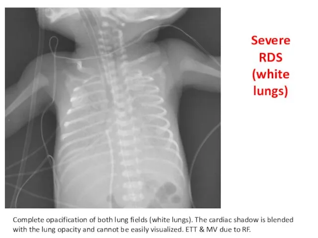 Severe RDS (white lungs) Complete opacification of both lung fields