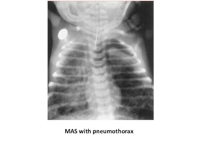 MAS with pneumothorax