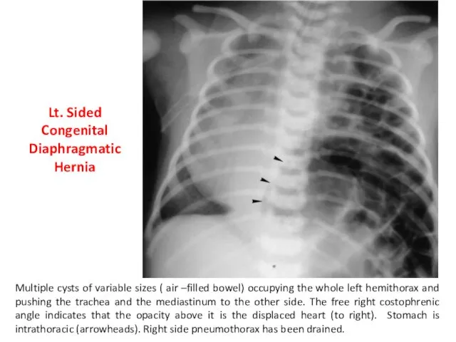 Multiple cysts of variable sizes ( air –filled bowel) occupying