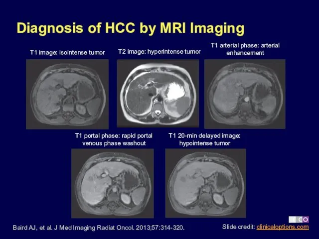 Diagnosis of HCC by MRI Imaging Baird AJ, et al. J Med Imaging
