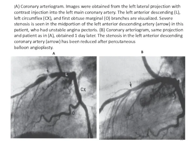 (A) Coronary arteriogram. Images were obtained from the left lateral projection with contrast