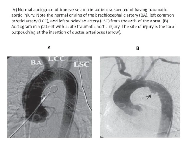 (A) Normal aortogram of transverse arch in patient suspected of having traumatic aortic