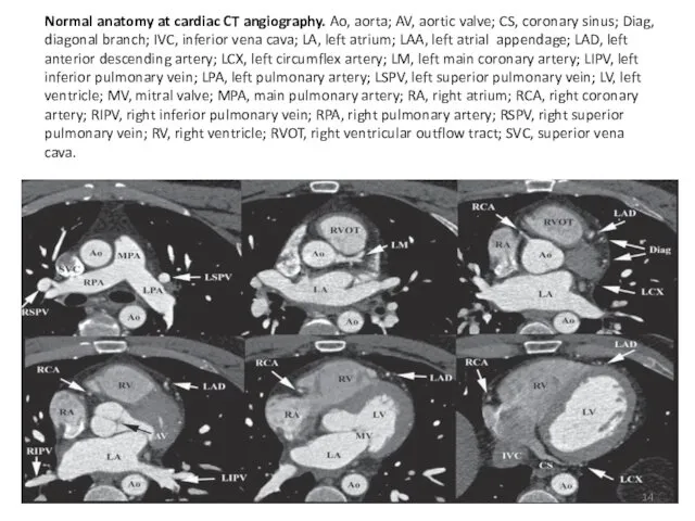 Normal anatomy at cardiac CT angiography. Ao, aorta; AV, aortic valve; CS, coronary