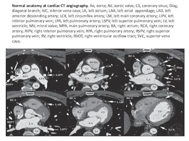 Normal anatomy at cardiac CT angiography. Ao, aorta; AV, aortic