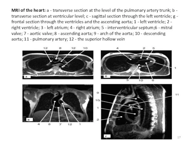 MRI of the heart: a - transverse section at the level of the