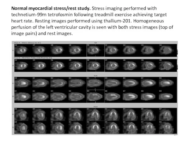 Normal myocardial stress/rest study. Stress imaging performed with technetium-99m tetrofosmin following treadmill exercise