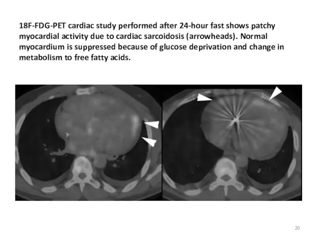 18F-FDG-PET cardiac study performed after 24-hour fast shows patchy myocardial activity due to