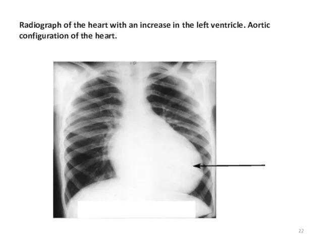 Radiograph of the heart with an increase in the left ventricle. Aortic configuration of the heart.