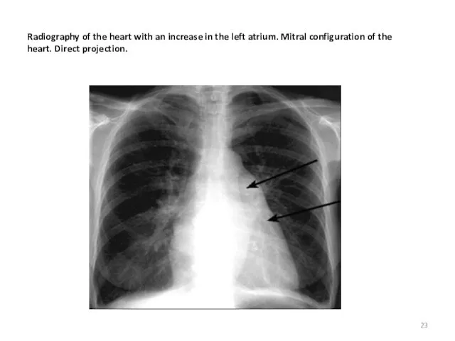 Radiography of the heart with an increase in the left atrium. Mitral configuration